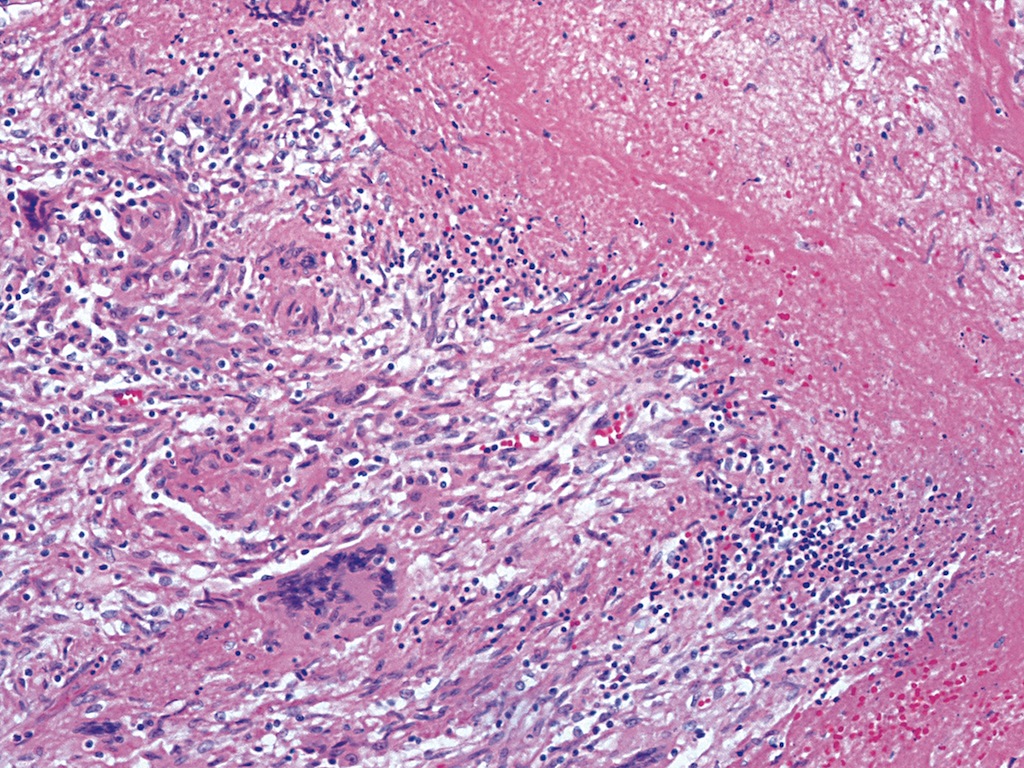 Pathology Outlines Tuberculous Osteomyelitis